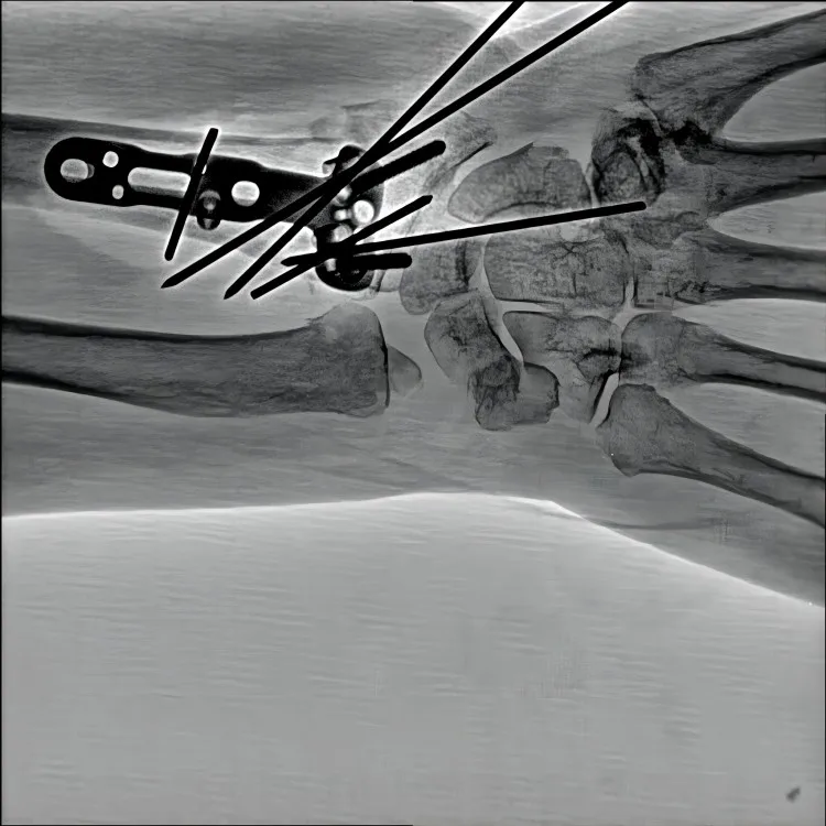 Oncology interventional treatment medical x ray c arm system