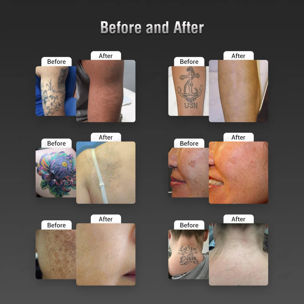 Professional buy nd yag laser q switched pico tattoo removal machine