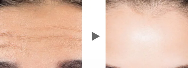 Forehead Microneedling Patch For Wrinkles And Fine Lines Reusable Hydrogel Long Microneedle Patch