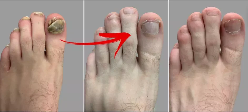 High power 60w nails onychomycosis toe nail fungus treatment machine new product 980nm diode laser for podiatry