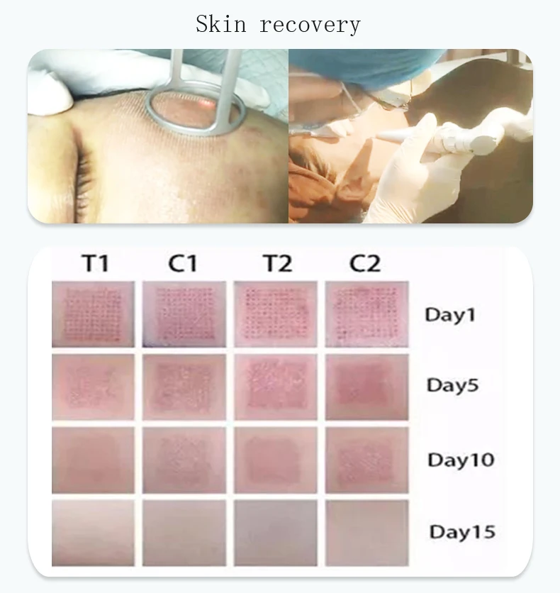 
Co2 Laser Portable Radio Frequency Face Lift Device Rf Beauty Instrument Equipment 