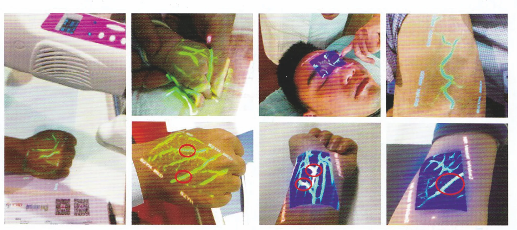 Medical Vein Finder System