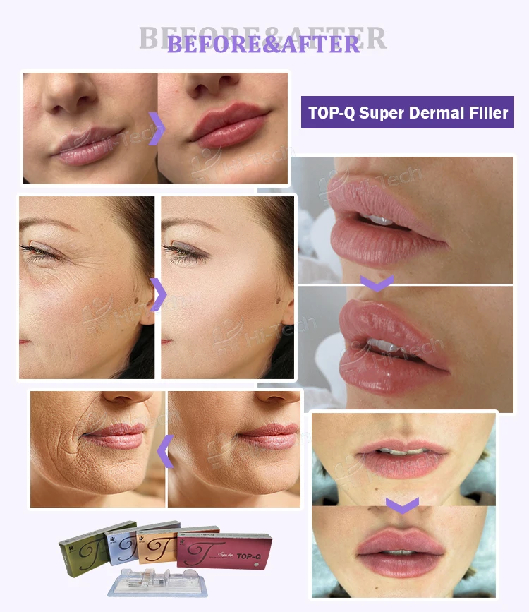 manufacturer wholesale Derm 1ml 2ml body lips filling beauty wrinkle acido hyaluroinic acid dermal filler