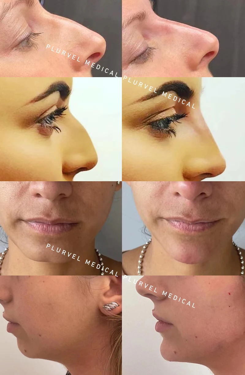 Plurvel 2ml Hyaluronic Acid Filler Injection Antiaging Injectable Facial Filler Gel For Lip Enhancement Nose Chin Filler