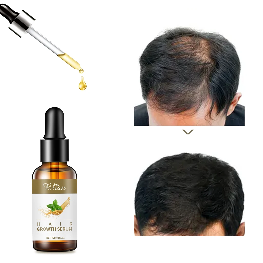2022 Hair Regrowth Oil Private Label Reduces Dandruff Moisturizing Hair Growth Oil Drops Biotin Oil Hair
