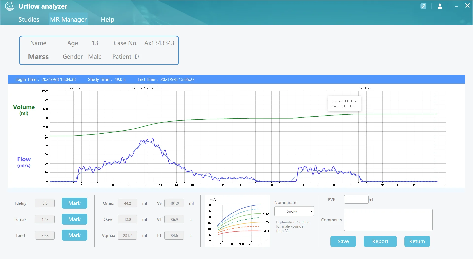 Urodynamics Test System Uroflowmetry In Bph Uroflow Normal Values