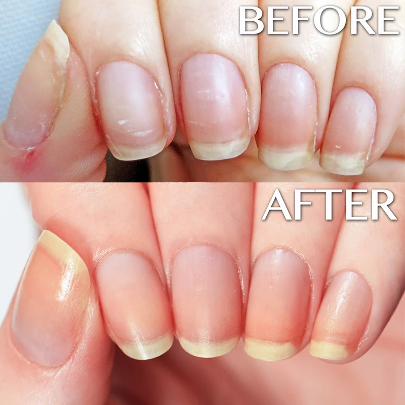Cuticle Oil Exfoliating Repair Softens Moisturizing Cuticle Area Protects Dry & Cracked Skin Strengthens Thin Nails Oil