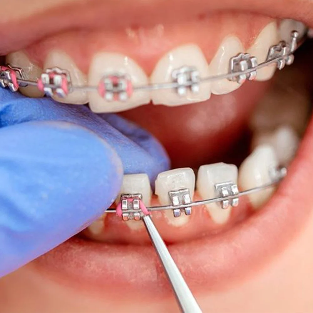 + Guber O-Ring Ligature Products Colored Orthodontic Dental Elastic Ligature Ties for Teeth Alignment
