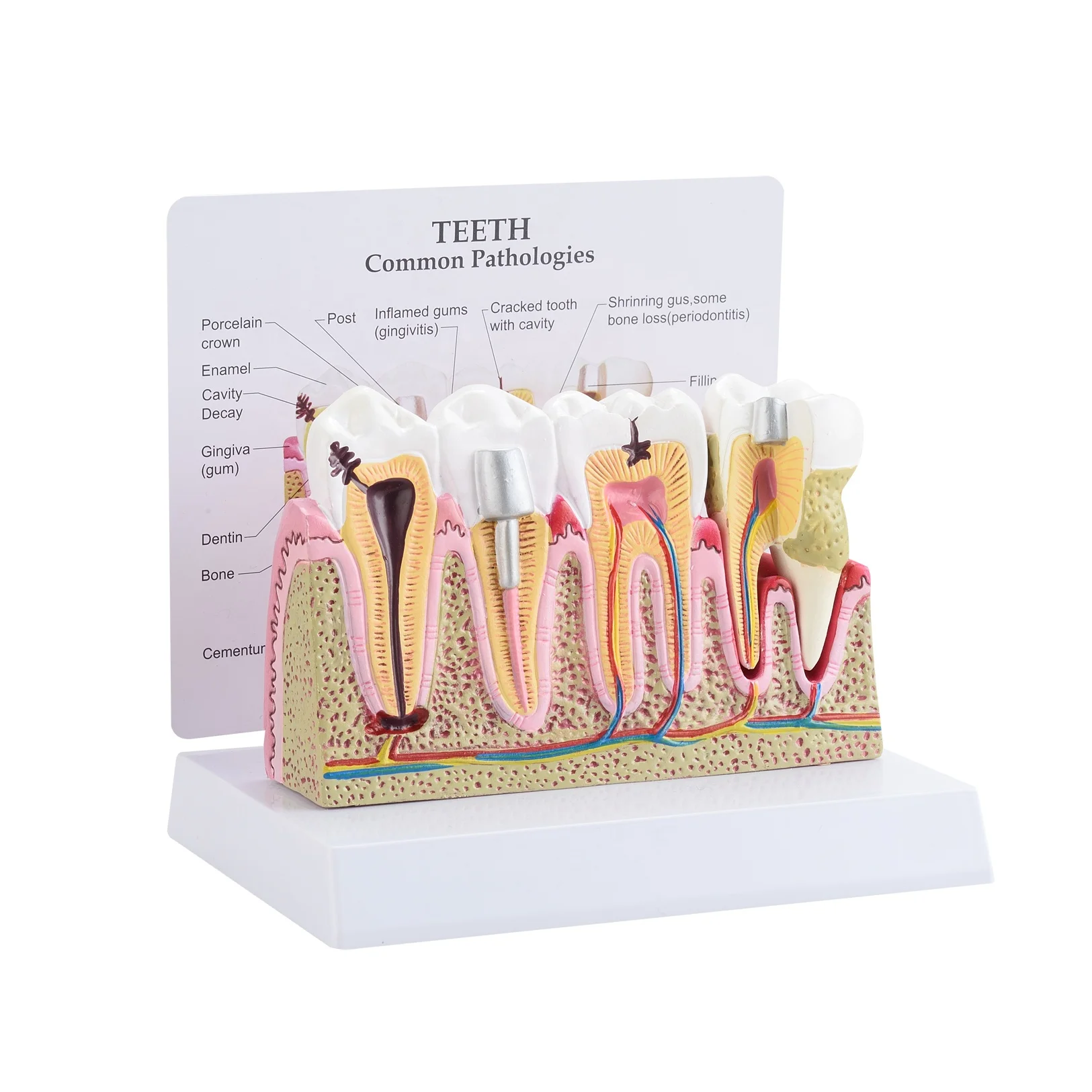 CBM-002E Education medical anatomical  model human teeth common pathologies model