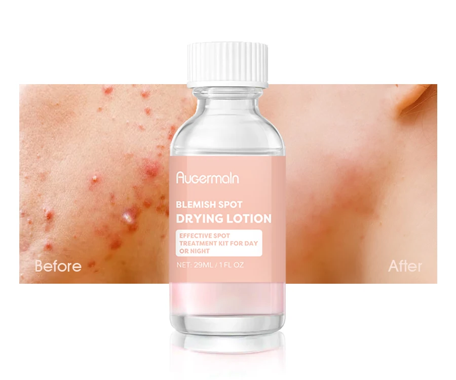 OEM Organic Calamin Acne Spot Treatment Serum Lotion and Pimple Patches for Face Pimple Remover Whitening Drying Lotion