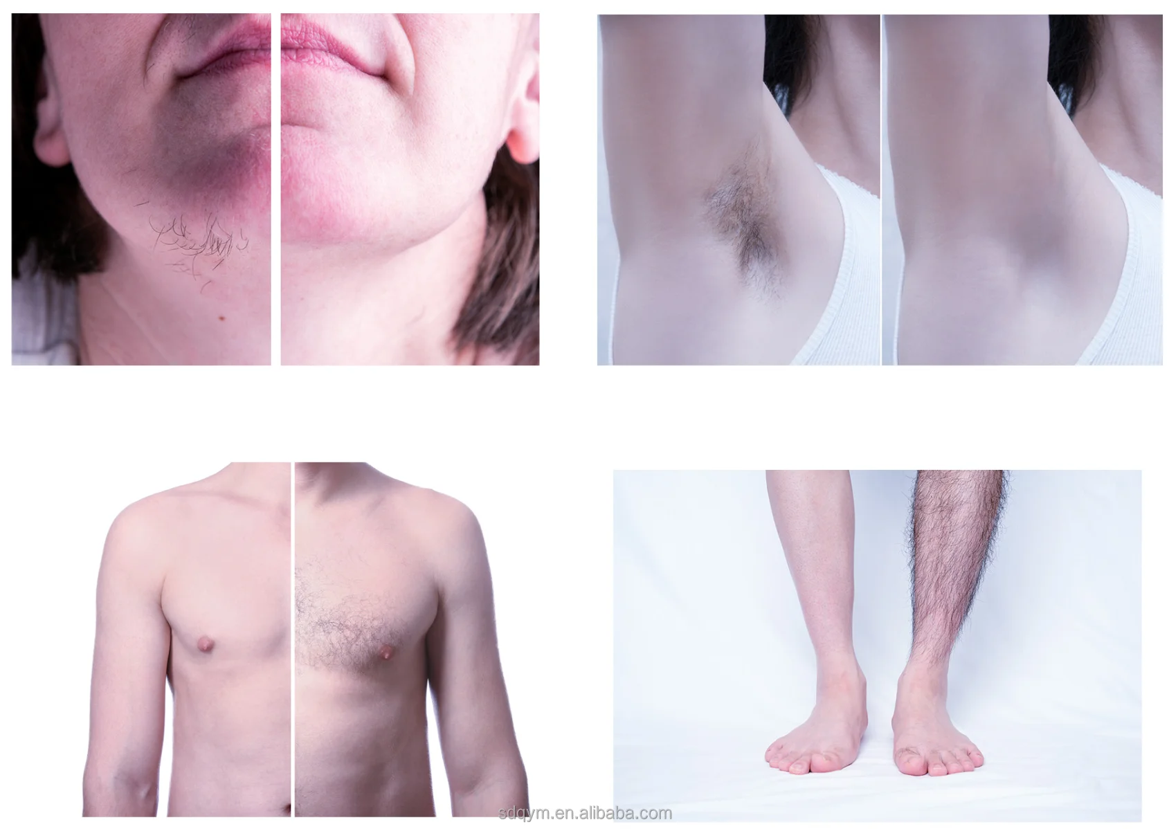 EXFU ICELL Big power 3000W diode laser 755 808 1064 diode laser 808nm hair removal laser hair removal machine price