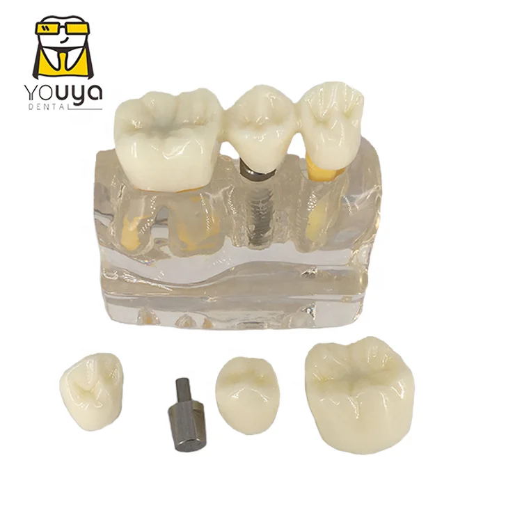 Dental Implant 4 Times Removable Teeth Model For Dental Clinic