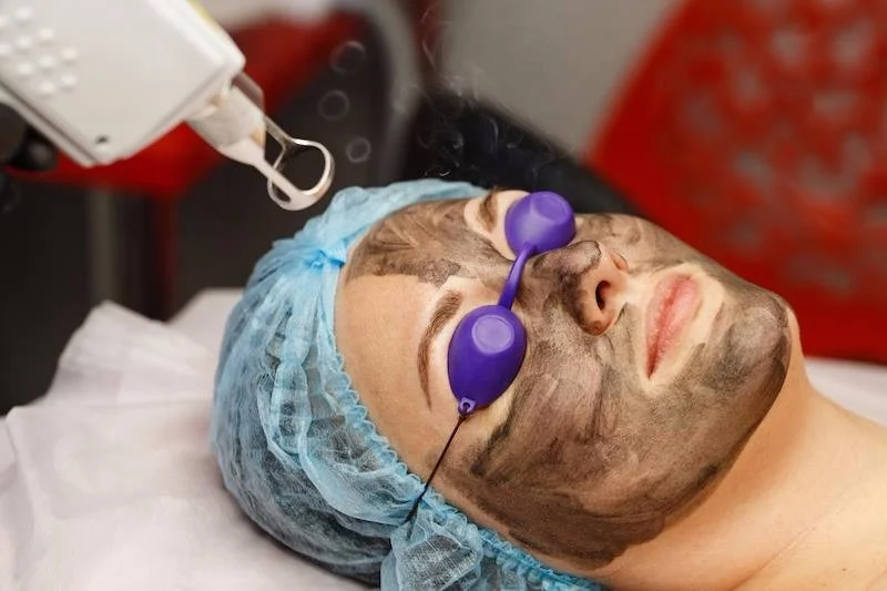 Profession Nd Yag Tattoo Removal Non Invasive Eyebrow Washing Freckle Carbon Doll 1064 532nm Nd Yag Laser Tattoo Removal Machine