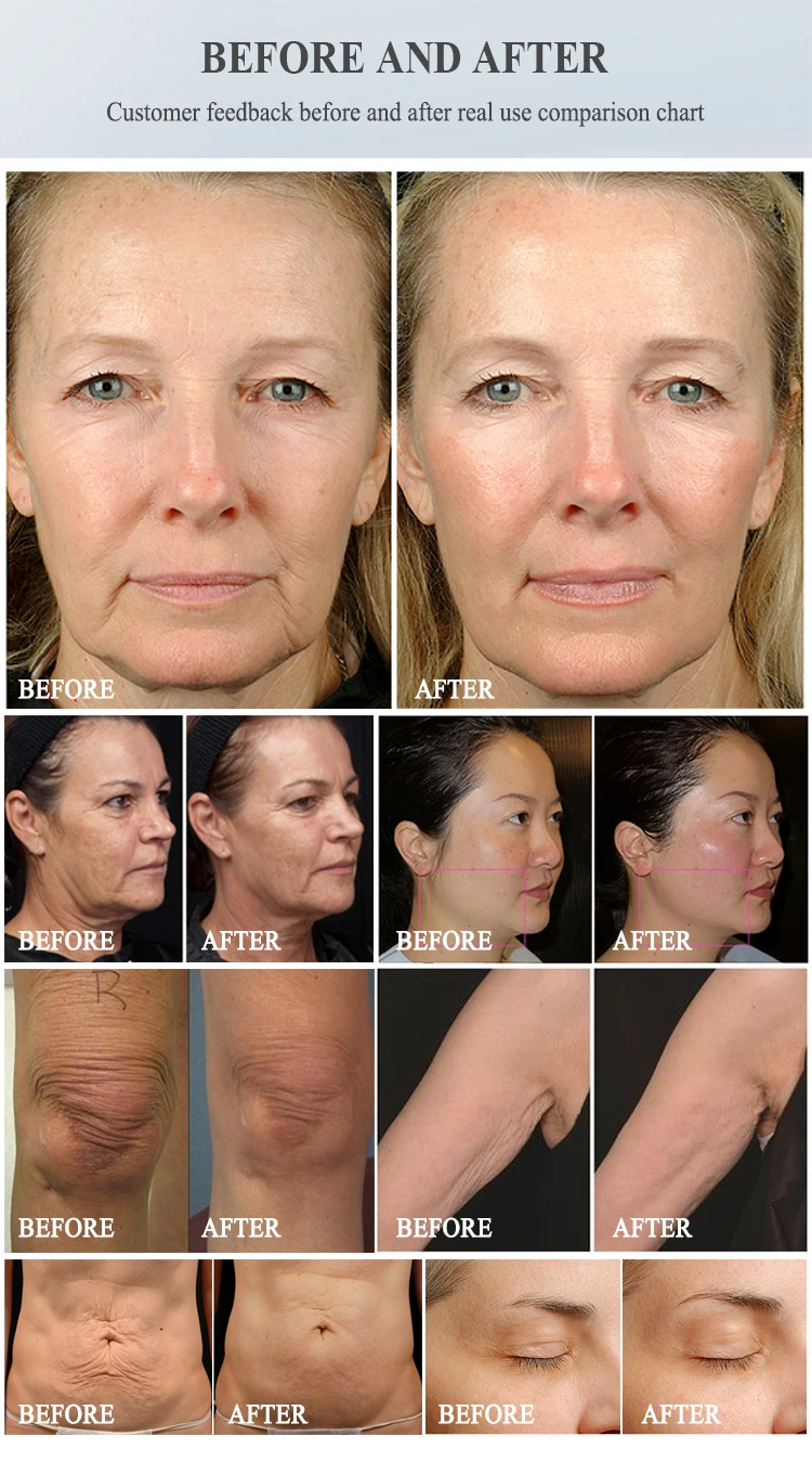 6.78mhz 360 RF Anti Wrinkle Beauty Equipment Radio Frequency For Skin Tightening RF Massage Lifting Machine