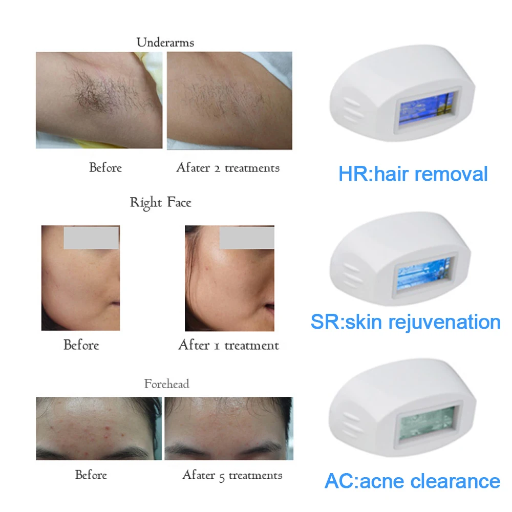 Mlay New 500000 Shots Home Use Mini Ipl Hair Removal Device With 3 Functions Lamps