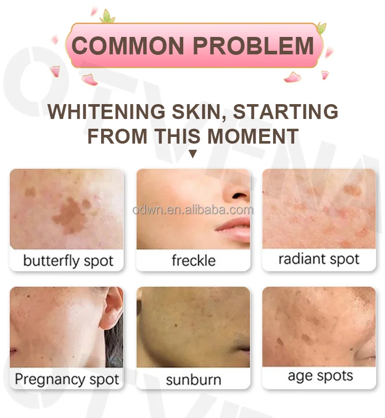 Oem Pimples Melasma blemish brighten dark spot corrector remover cream Strong bleaching whitening face freckle remove cream