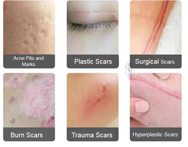 OEM Multi-color Scar Removal Private Label Skin Care Plaster Pink Blue Tape Silicone Scar Sheet