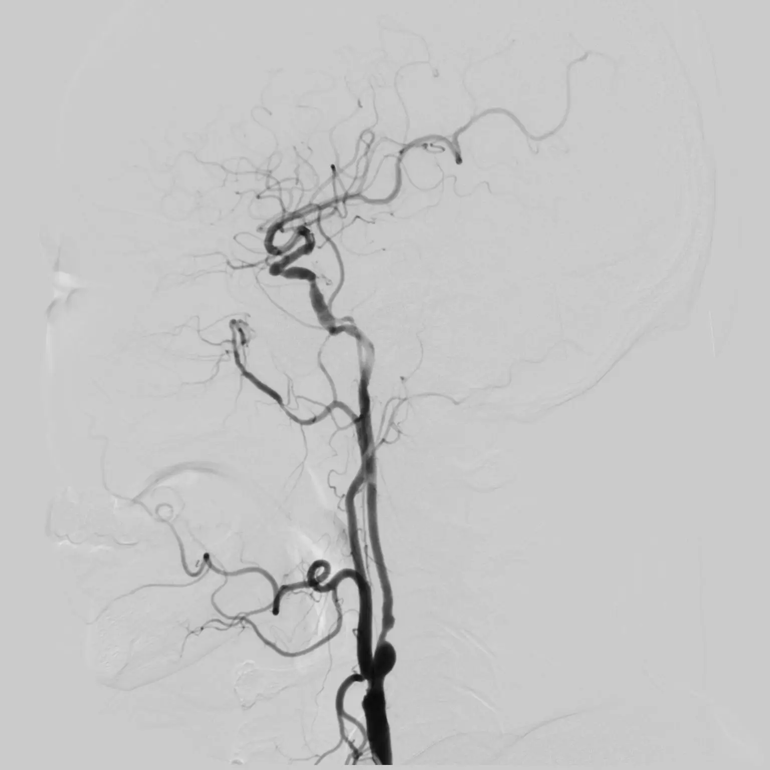 Ultra-smart Medical X-ray System For Ventricular Digital Subtraction Angiography