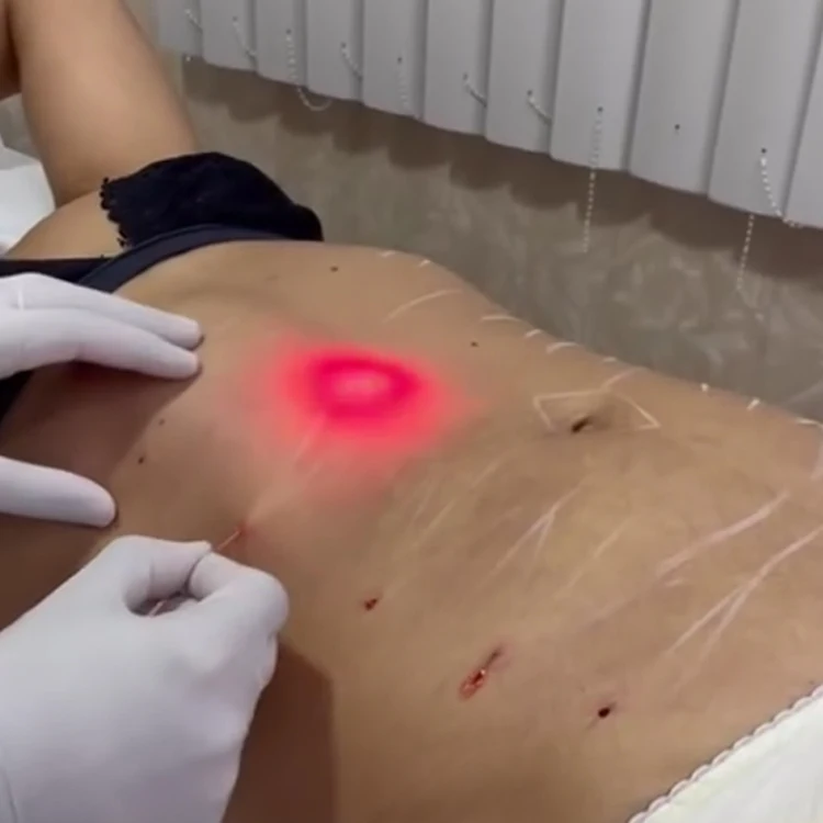 2024 professional endolaser 1470nm fiber laser face lifting 980nm skin tightening facial machine