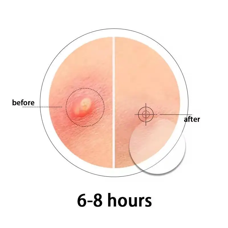 Customized Packing Tea Tree Oil Invisible Waterproof Hydrocolloid Patch Acne Healing Pimple Patches For Skin Care