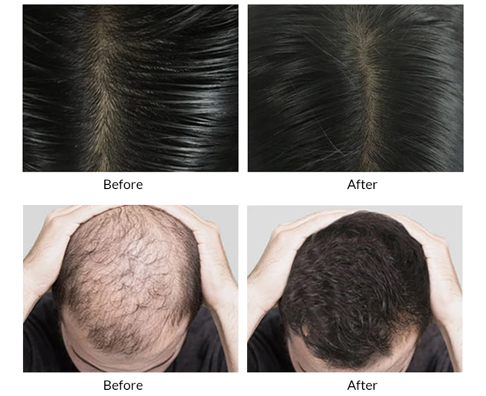 OMYLADY shampoo and conditioner set hair loss treatment tonic keratin cream for hair