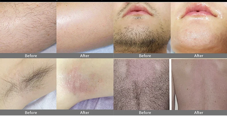 professional laser hair removal machine  Hand Hair Removal Diode Laser 755 808 1064 diode laser Hair Removal Machine