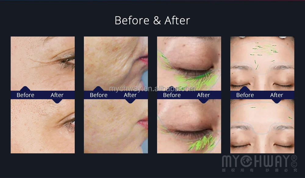 Snow Ice Cooled RF Radio Frequency Skin Tightening Facial Care Beauty Machine