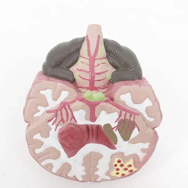 BMN/N051 Brain Stroke Model (Brain Disease Model)