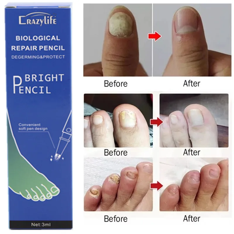 Nail Repair Anti Fungal Treatment Nail Pen Onychomycosis Paronychia Infection Toe Finger Nail Nutrition Health OEM