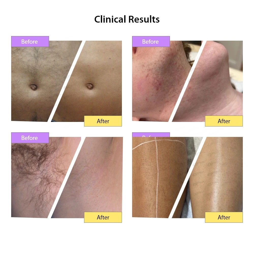 Best sale 4 waves 1200w diode laser hair removal machine 2 in 1 hair laser machine removal