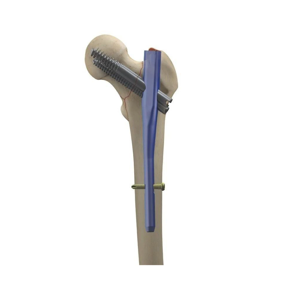 China Manufacturer Intertan Intramedullary Nail orthopedic nails and screws Titanium