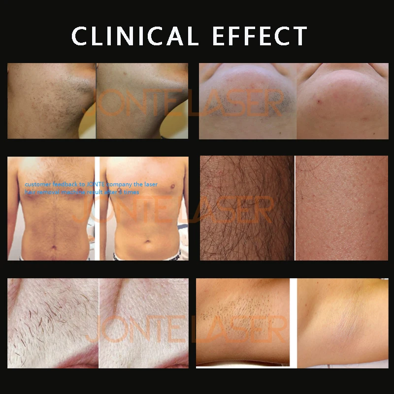 Android System Approved Medical CE MDR 808nm 600w 1200w 808nm Diode Laser Hair Removal Device