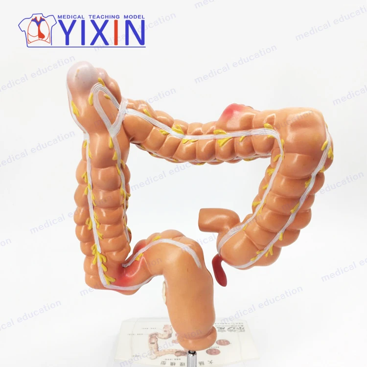
YIXIN/Model of human colon disease Model of large intestine Pathological,Disease Large Intestines 