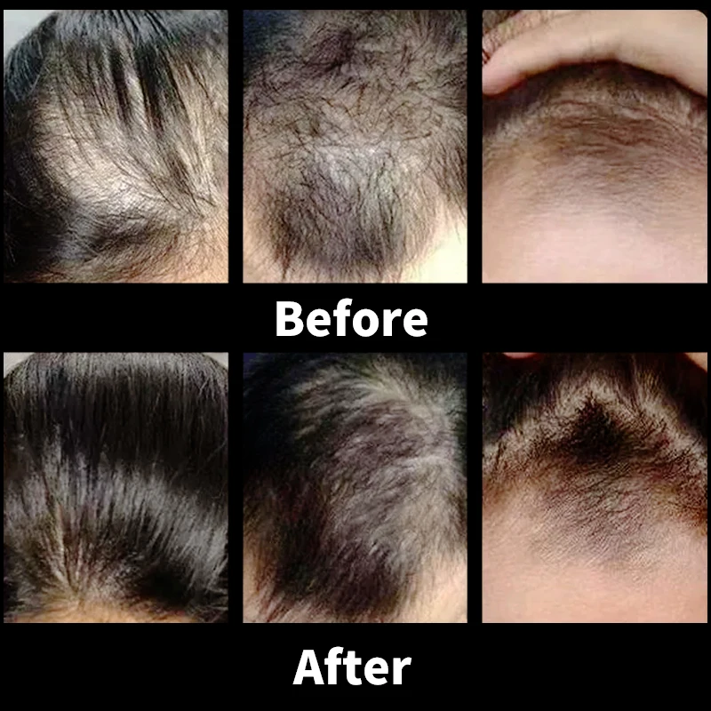 Anti-hair Loss Anti- Dandruff Treatments  Repair Promote Hair Growth for Men and Women Volumising Shampoo Hair Wash