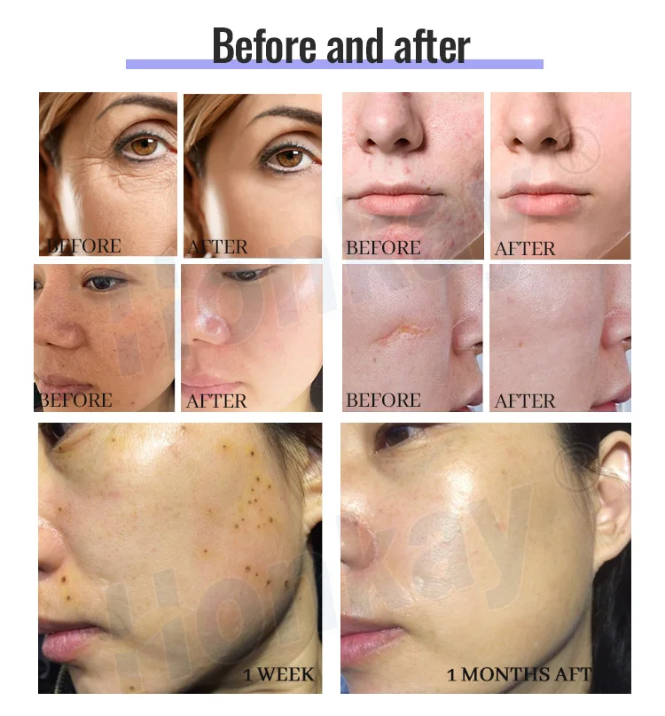 new plasma pen skin care plasma rf ems wrinkle remove skin rejuvenation plasma pen mole remove machine