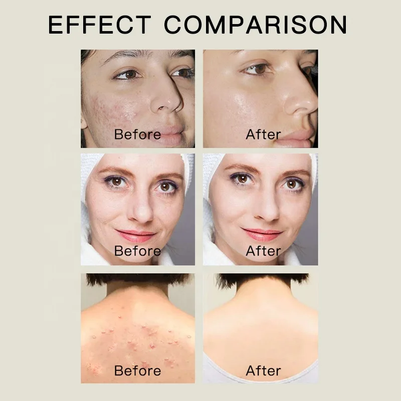 Горячая Распродажа Новое поступление мыло от Ekber Skin Miracle контроль жирности куркума алоэ уголь для ухода за кожей лица