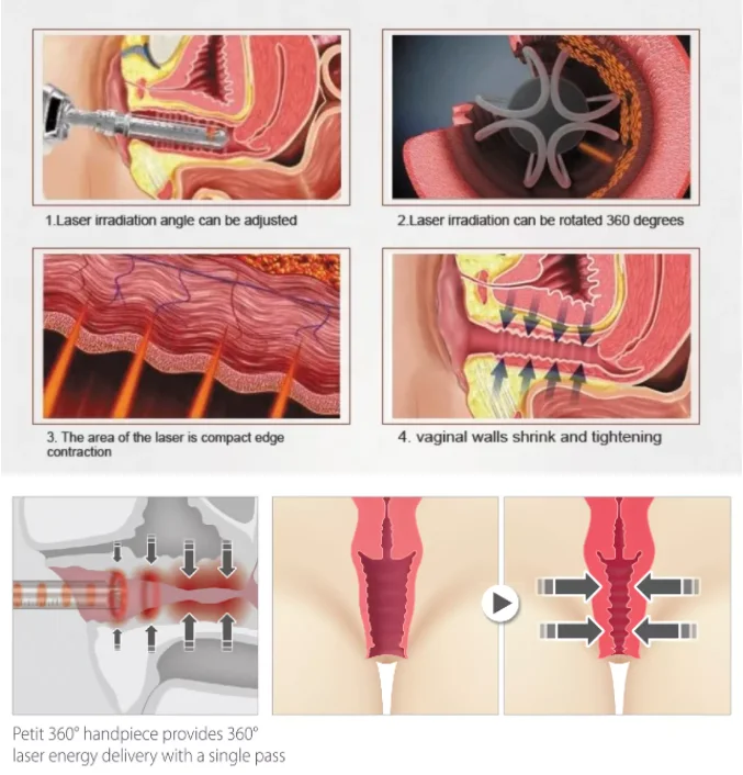 Гинекологический лазер с двойной длиной волны нм и гинекологический аппарат для укрепления влагалища омоложения
