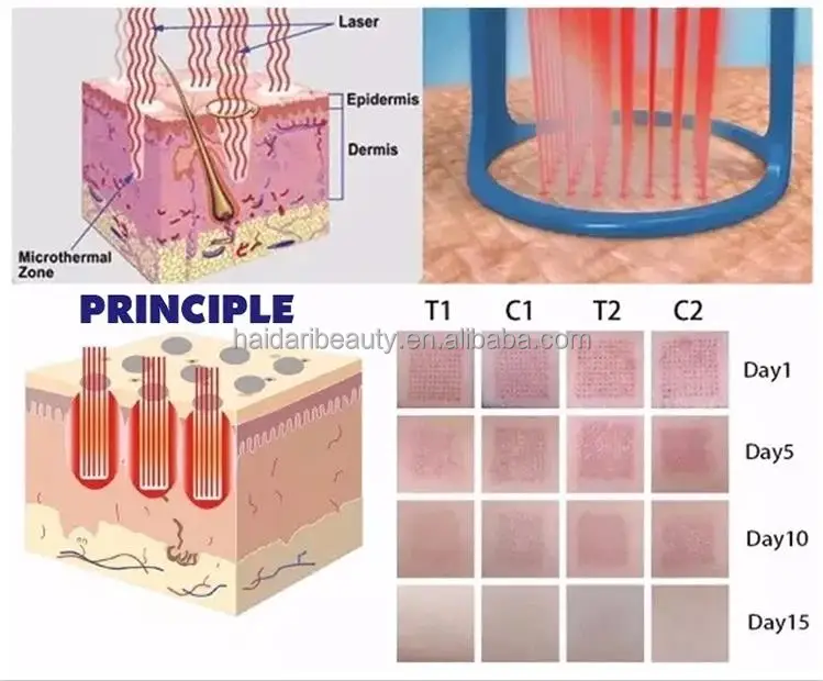 factory Erbium Glass fiber Fractional Laser 1550nm beauty Equipment non-ablative machine for Acne removal Face lifting