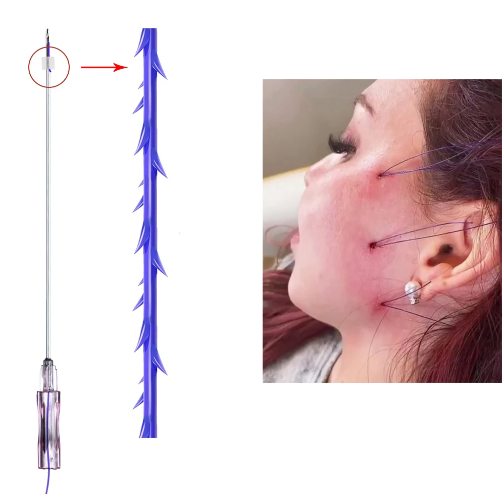 Facial contour changes absorbable thread lift face pdo 3d 4d cog thread lifting pdo thread
