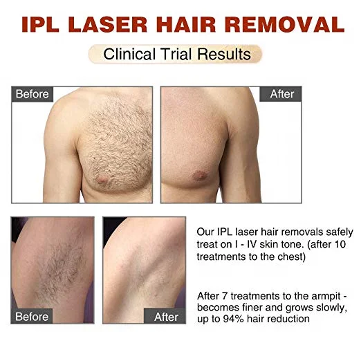 Портативный лазерный аппарат Mismon, домашний лазерный эпилятор для удаления волос IPL