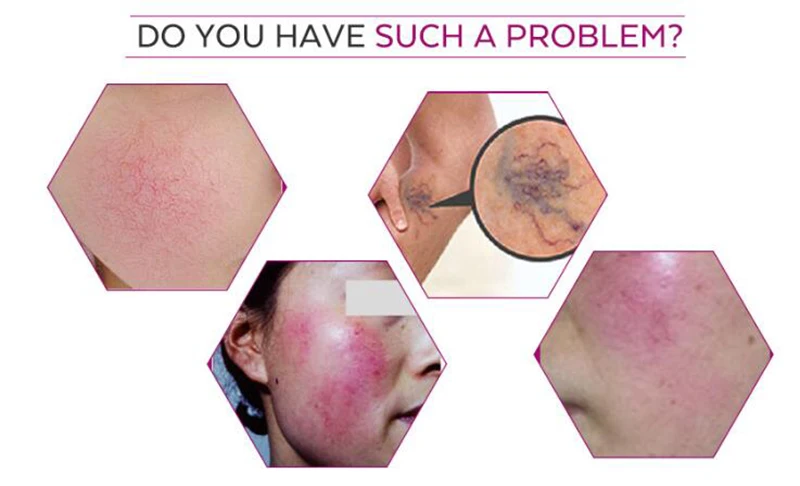 Red Blood Vessels 980nm Spider Veins Removal Diode Laser 980 nm Varicose Veins Laser Treatment Machine