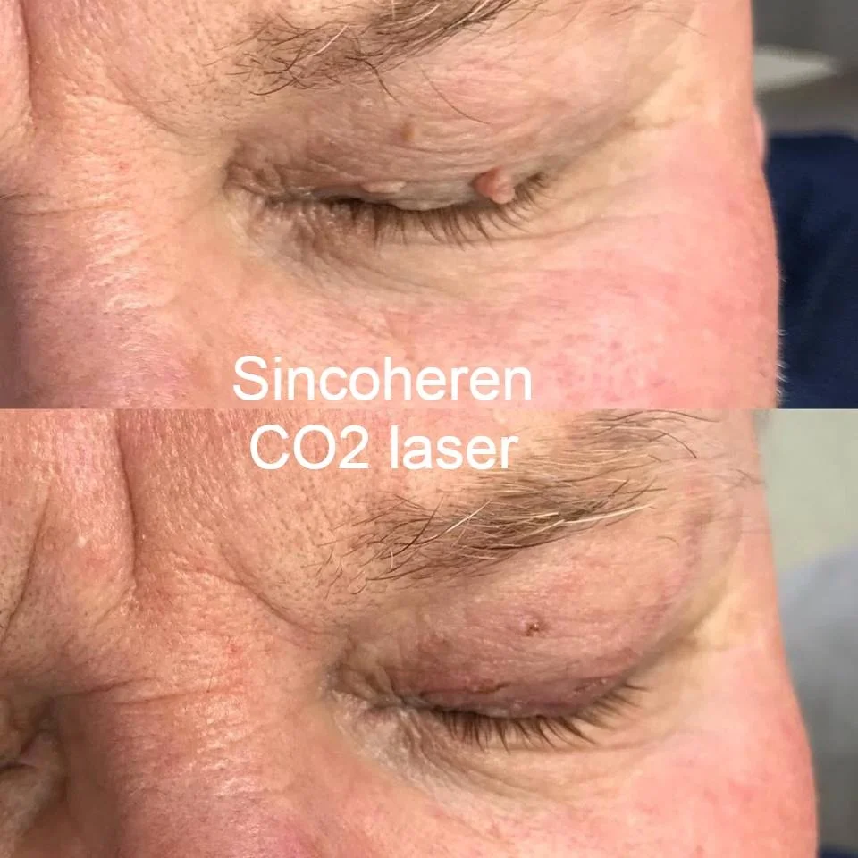 Med Spa use Medical grade Fractional CO2 Laser machine to remove scar acne skin tag and for uneven skin tone vaginal treatment