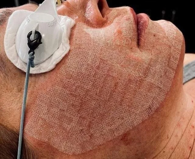 New Trend Skin Care Skin Whitening Fractional Co2 Laser Skin Resurfacing Machine For Beauty Salon