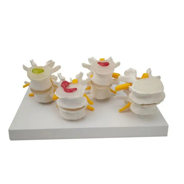 
The diseased model of vertebrae 