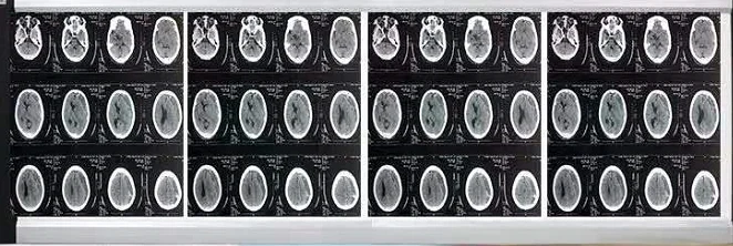 Medical LED single double panel  Negatoscope Box X-ray film viewer