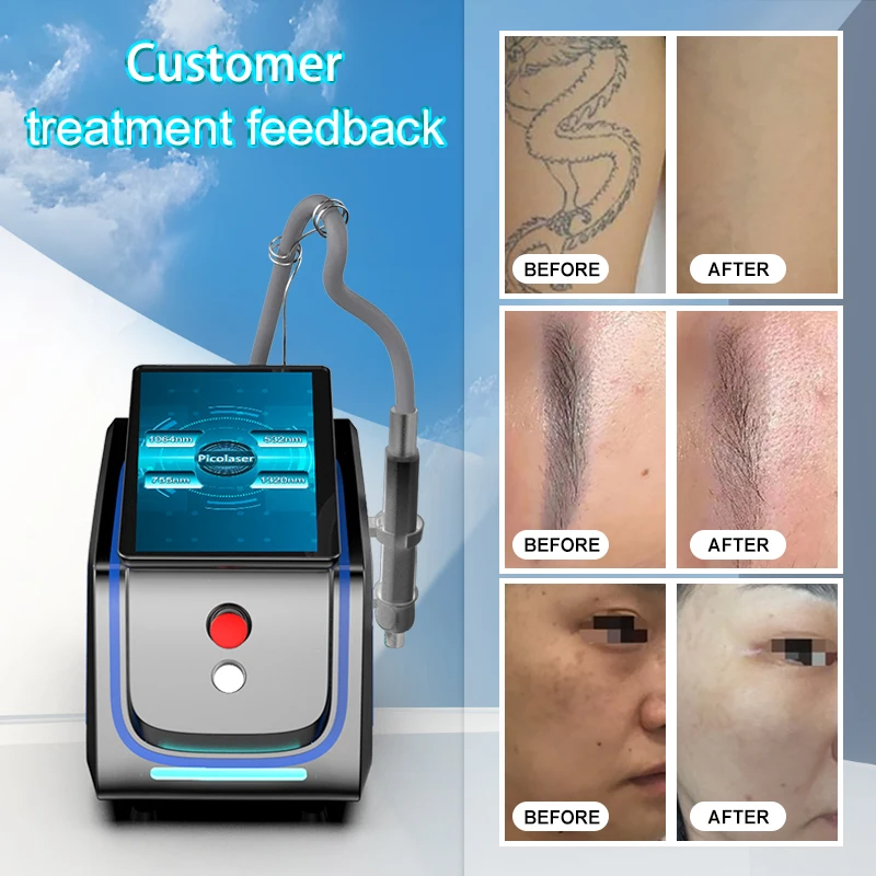 Hongqi Picosecond 1064nm 755nm 532nm Pico q switched Nd Yag Lasering Pico Lasering Tattoo Removal Picosecond lasering machine