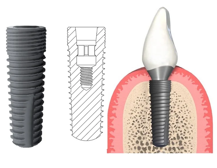implantes dentales Tooth Fixture S.L.A Surface Dental Implant Dental Screws OEM Narrow/Regular