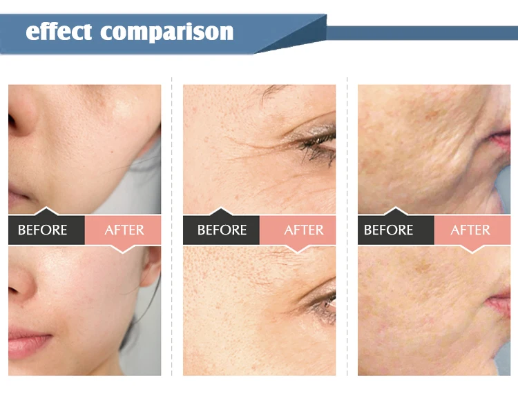 Mini Meso Injector Mesotherapy Needle EMS Water Injection Facial Care Whitening Radio Frequency Machine with RF