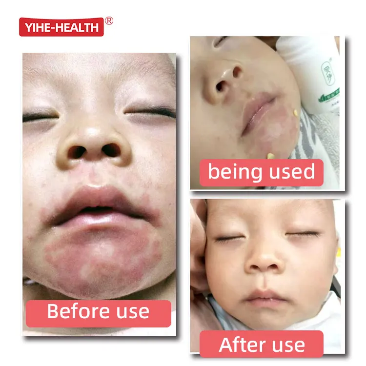 YIHE-HEALTH крем для восстановления кожи пеленки сыпь экзема у