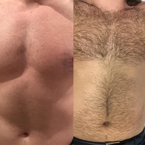 Seek Agents laser hair removal machine professional portable medical808